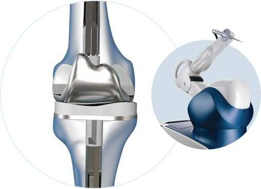 Revision Hip Knee Replacement