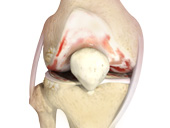 Knee Arthritis