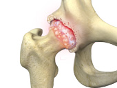 Hip Arthritis