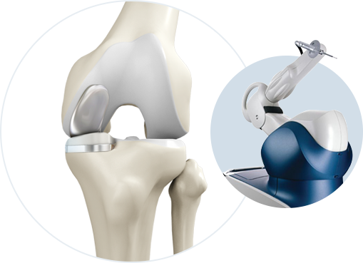 Robotic Partial Knee Replacement