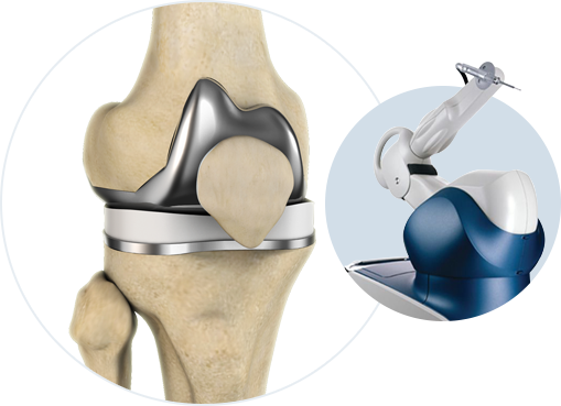 Robotic Total Hip Replacement