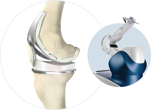 Robotic Total Knee Replacement