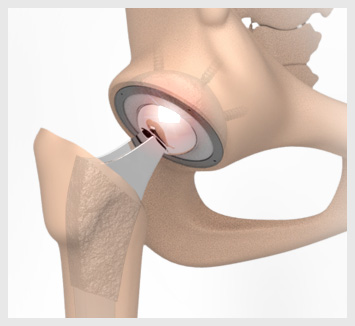 Robotic Total Hip Replacement